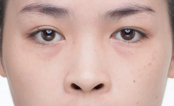 จมูก · ลดปีกจมูก — ก่อน