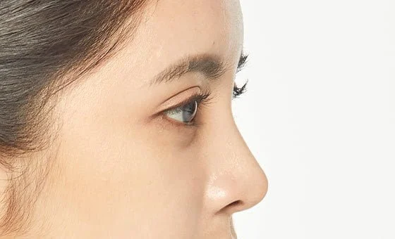 จมูก · เสริมจมูก — หลัง
