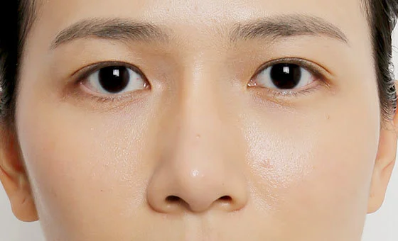 จมูก · ศัลยกรรมแก้ไข — ก่อน