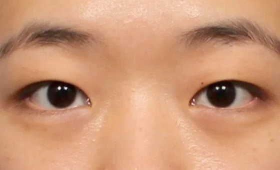 ตา · เปิดหัวตา/หางตา — ก่อน
