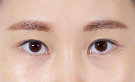 ตา · ศัลยกรรมแก้ไข — ก่อน