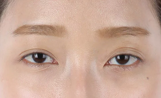 ตา · ศัลยกรรมแก้ไข — ก่อน