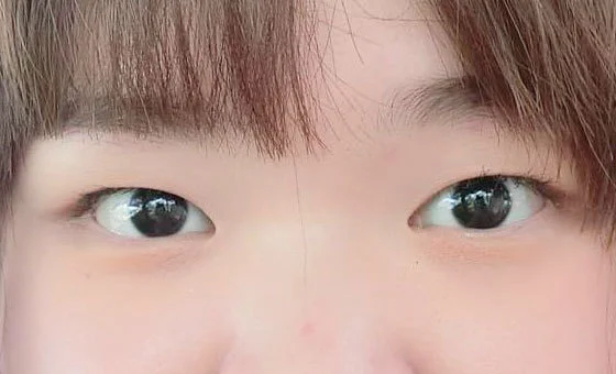 ตา · แก้ไขกล้ามเนื้อตาอ่อนแรง — ก่อน