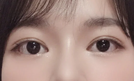 ตา · แก้ไขกล้ามเนื้อตาอ่อนแรง — หลัง