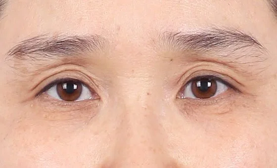 ตา · ศัลยกรรมเปลือกตา — ก่อน