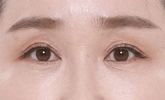 ตา · ศัลยกรรมเปลือกตา — หลัง