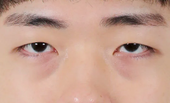 ตา · ใต้ตา — ก่อน
