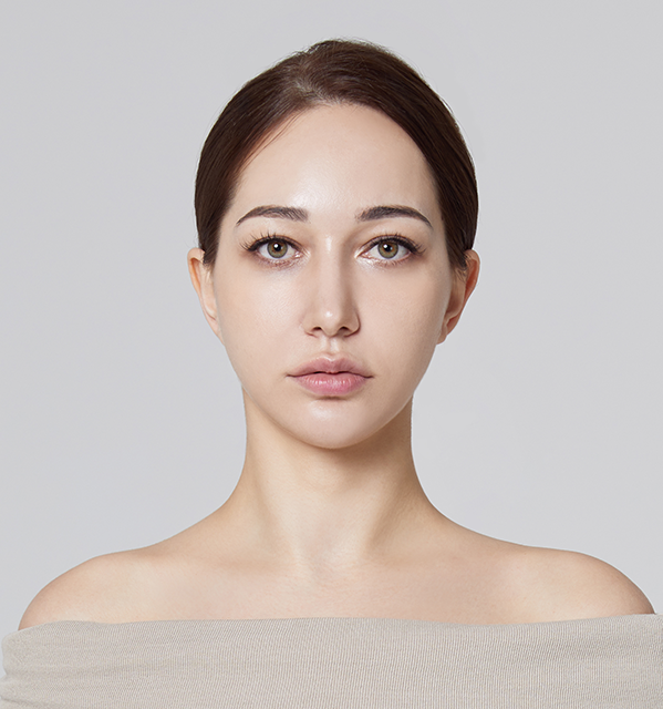 ยกหน้าผาก Endotine + ยกกระชับใบหน้าส่วนล่าง + ยกกระชับลำคอ + Accusculpt — หลัง