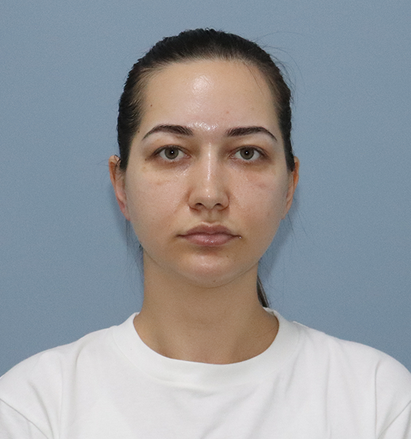 ยกหน้าผาก Endotine + ยกกระชับใบหน้าส่วนล่าง + ยกกระชับลำคอ + Accusculpt — ก่อน