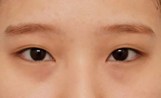 ตา · ตาสองชั้น — ก่อน